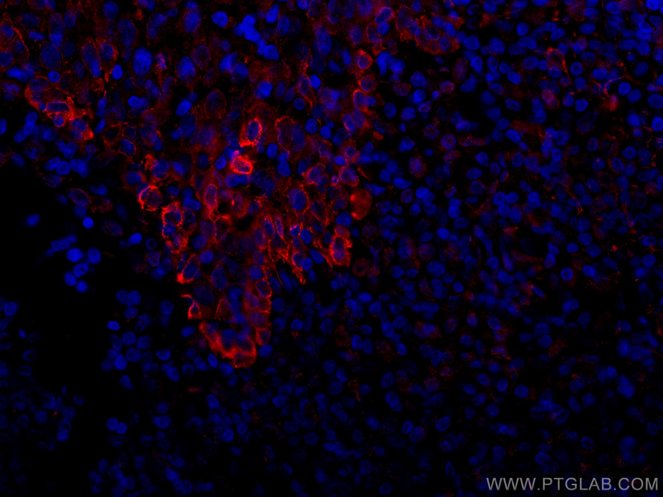 Immunofluorescence (IF) / fluorescent staining of human tonsillitis tissue using CoraLite®594-conjugated TLR8 Monoclonal antibody (CL594-67317)