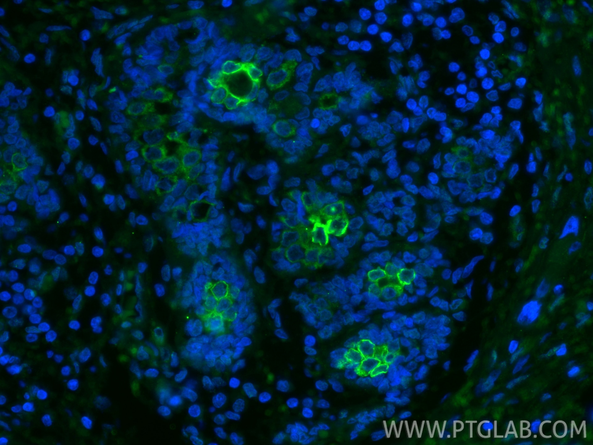 Immunofluorescence (IF) / fluorescent staining of human breast cancer tissue using FITC Plus-conjugated TLR8 Monoclonal antibody (FITC-67317)