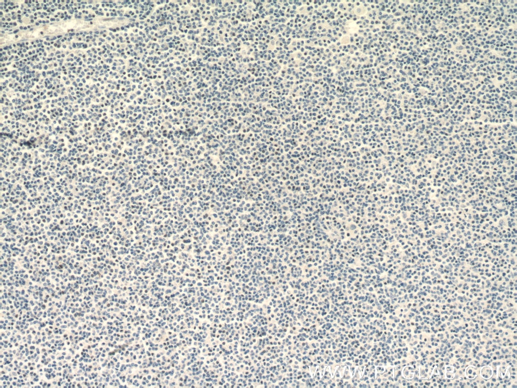 IHC staining of human lymphoma using 26877-1-AP