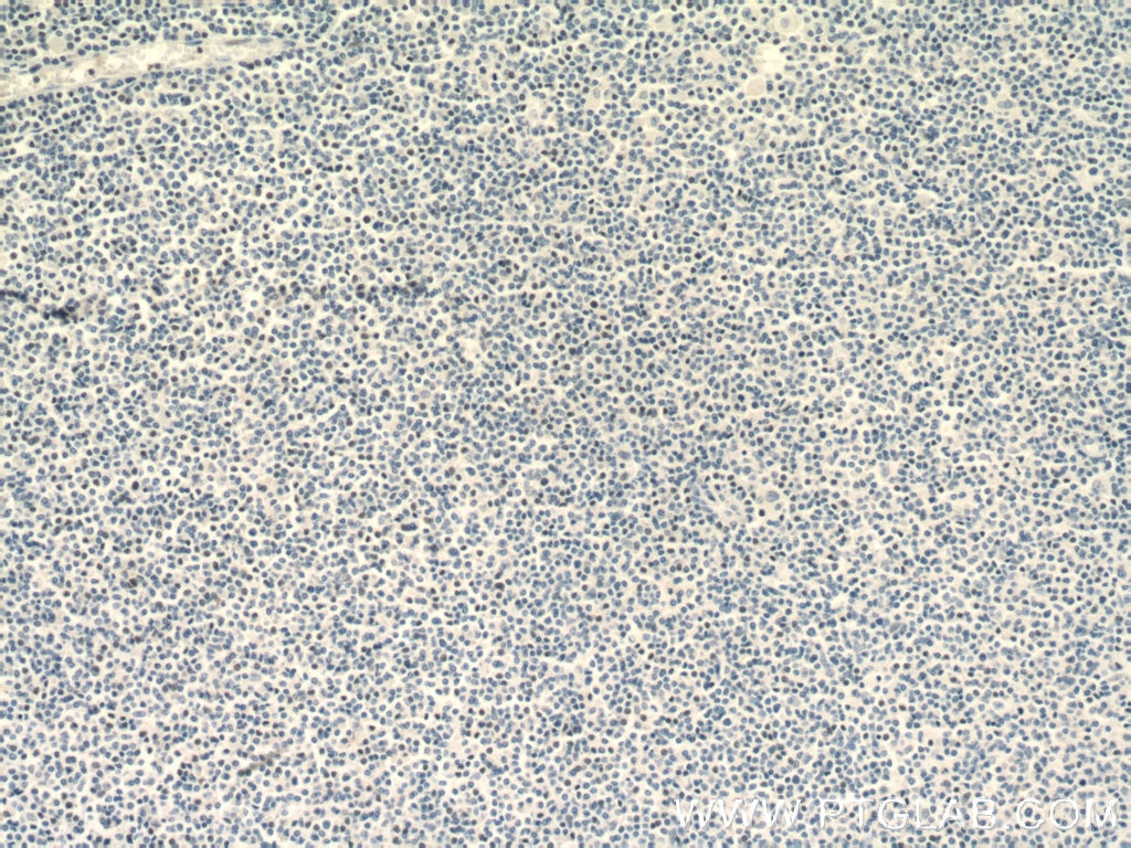 Immunohistochemistry (IHC) staining of human lymphoma tissue using TLX1 Polyclonal antibody (26877-1-AP)