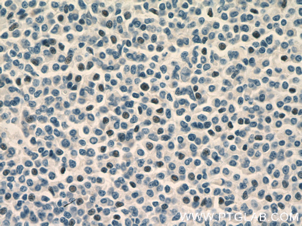 Immunohistochemistry (IHC) staining of human lymphoma tissue using TLX1 Polyclonal antibody (26877-1-AP)