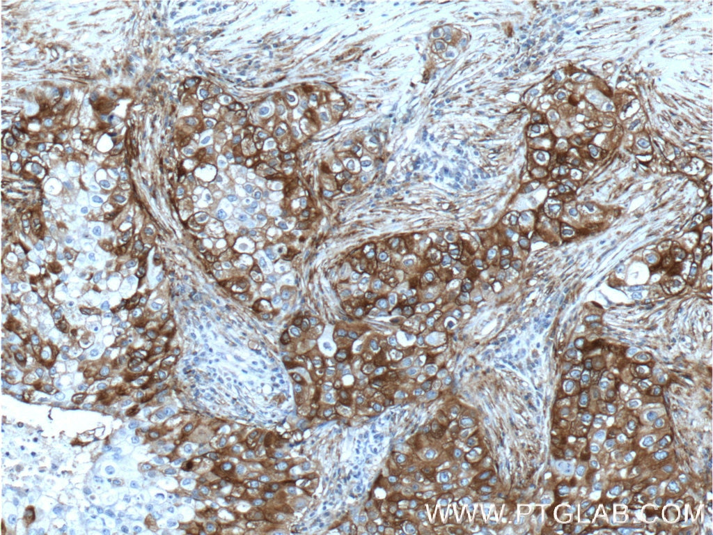 Immunohistochemistry (IHC) staining of human breast cancer tissue using TM4SF1 Polyclonal antibody (11093-1-AP)