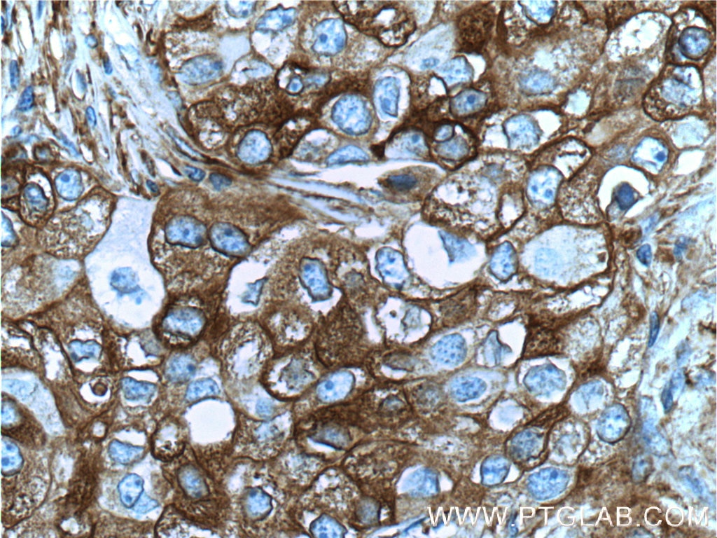 Immunohistochemistry (IHC) staining of human breast cancer tissue using TM4SF1 Polyclonal antibody (11093-1-AP)