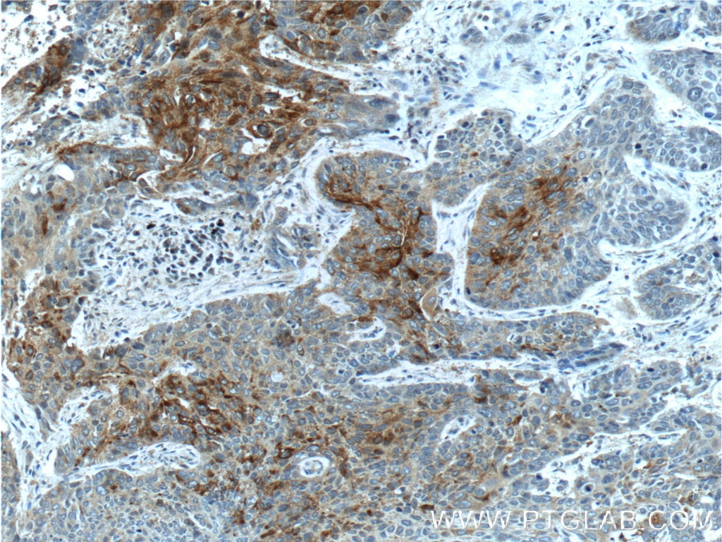 Immunohistochemistry (IHC) staining of human lung cancer tissue using TM4SF1 Polyclonal antibody (11093-1-AP)