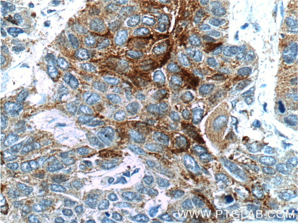 Immunohistochemistry (IHC) staining of human lung cancer tissue using TM4SF1 Polyclonal antibody (11093-1-AP)