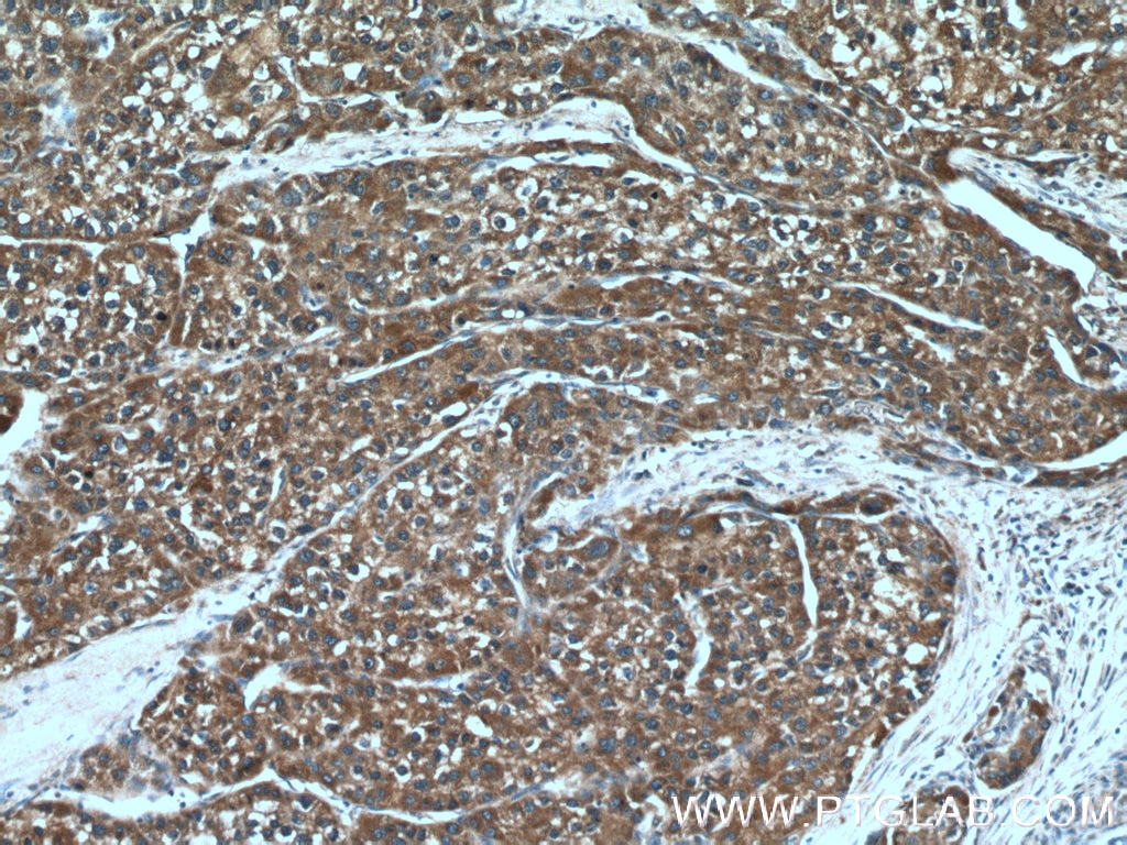 Immunohistochemistry (IHC) staining of human liver cancer tissue using TM4SF5 Polyclonal antibody (18239-1-AP)