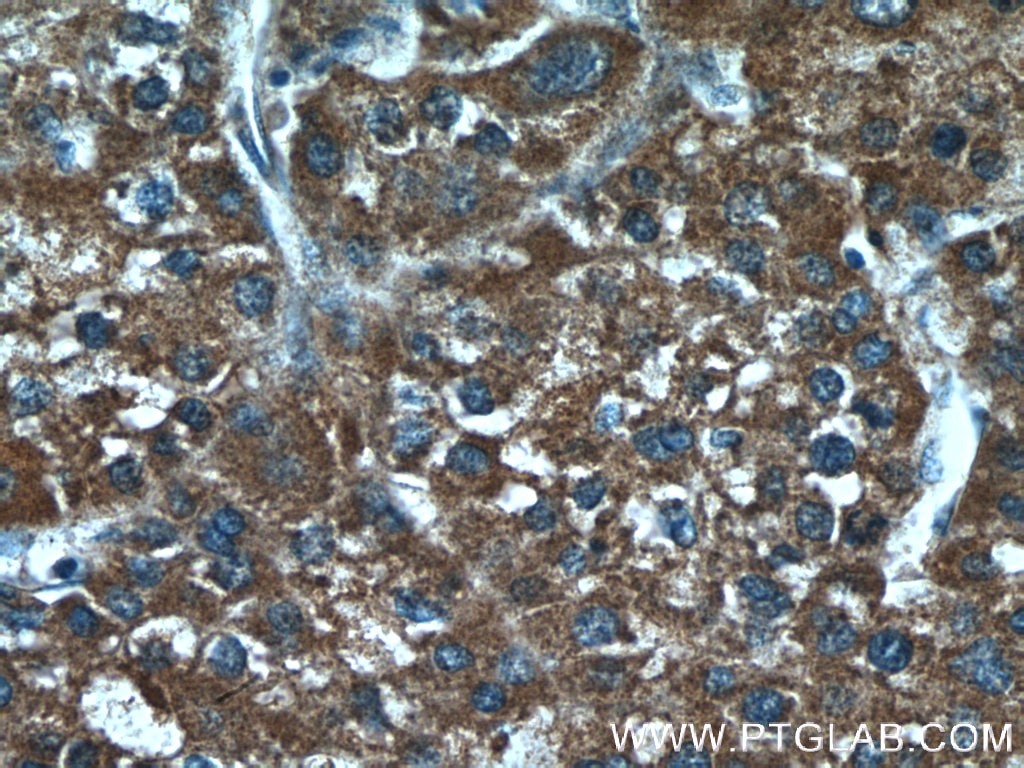 Immunohistochemistry (IHC) staining of human liver cancer tissue using TM4SF5 Polyclonal antibody (18239-1-AP)