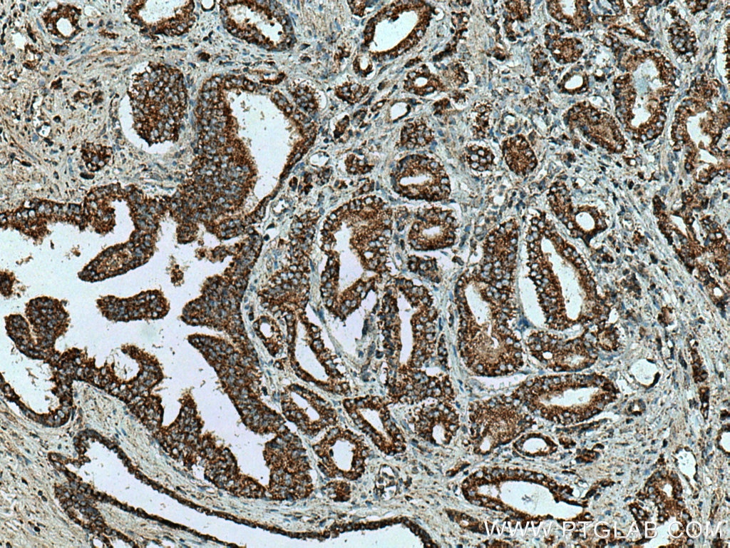 Immunohistochemistry (IHC) staining of human prostate cancer tissue using TM7SF2 Polyclonal antibody (12033-1-AP)