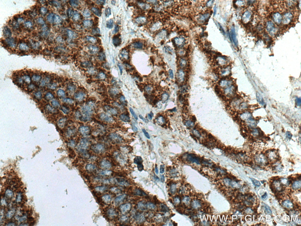 Immunohistochemistry (IHC) staining of human prostate cancer tissue using TM7SF2 Polyclonal antibody (12033-1-AP)