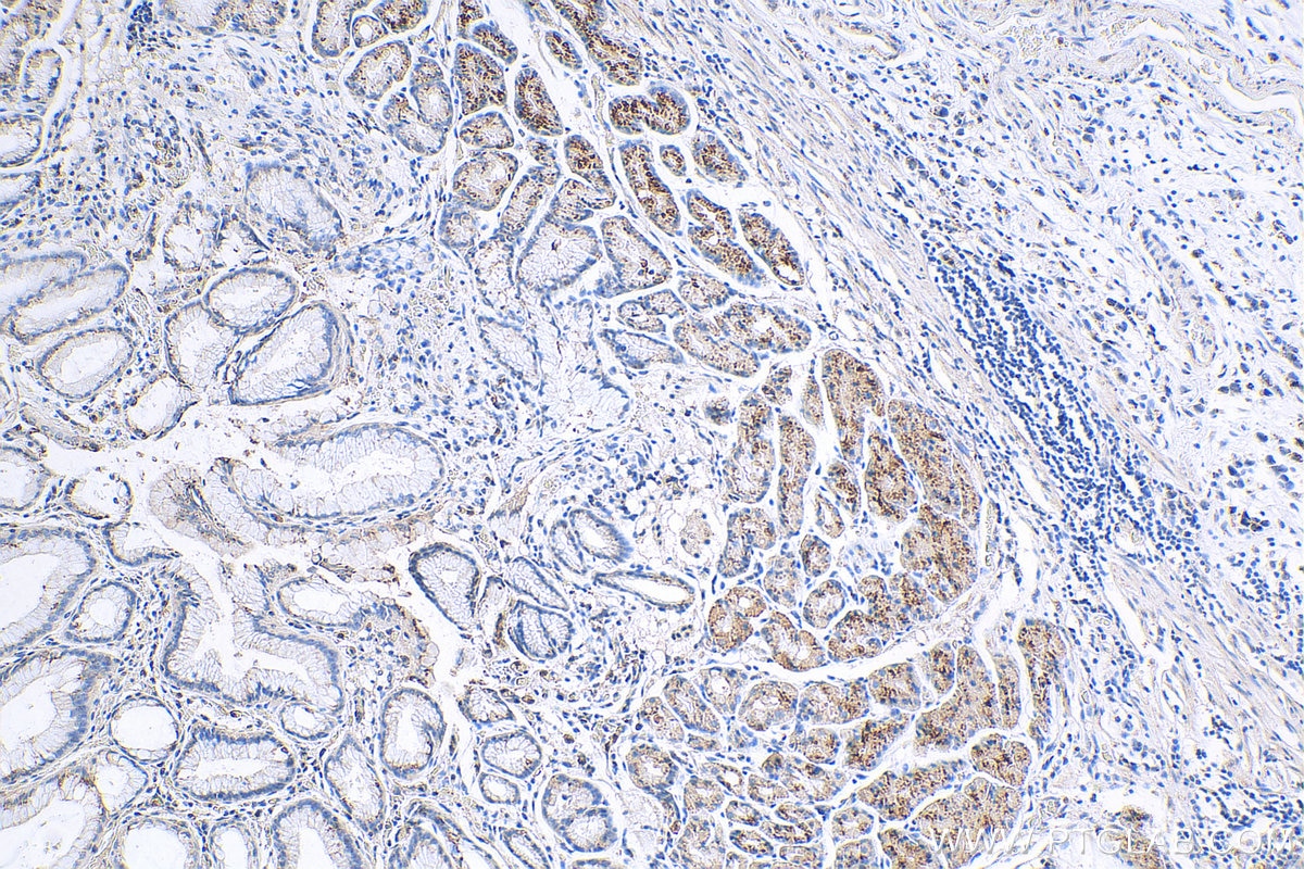 Immunohistochemistry (IHC) staining of human stomach cancer tissue using TM9SF4 Polyclonal antibody (29520-1-AP)