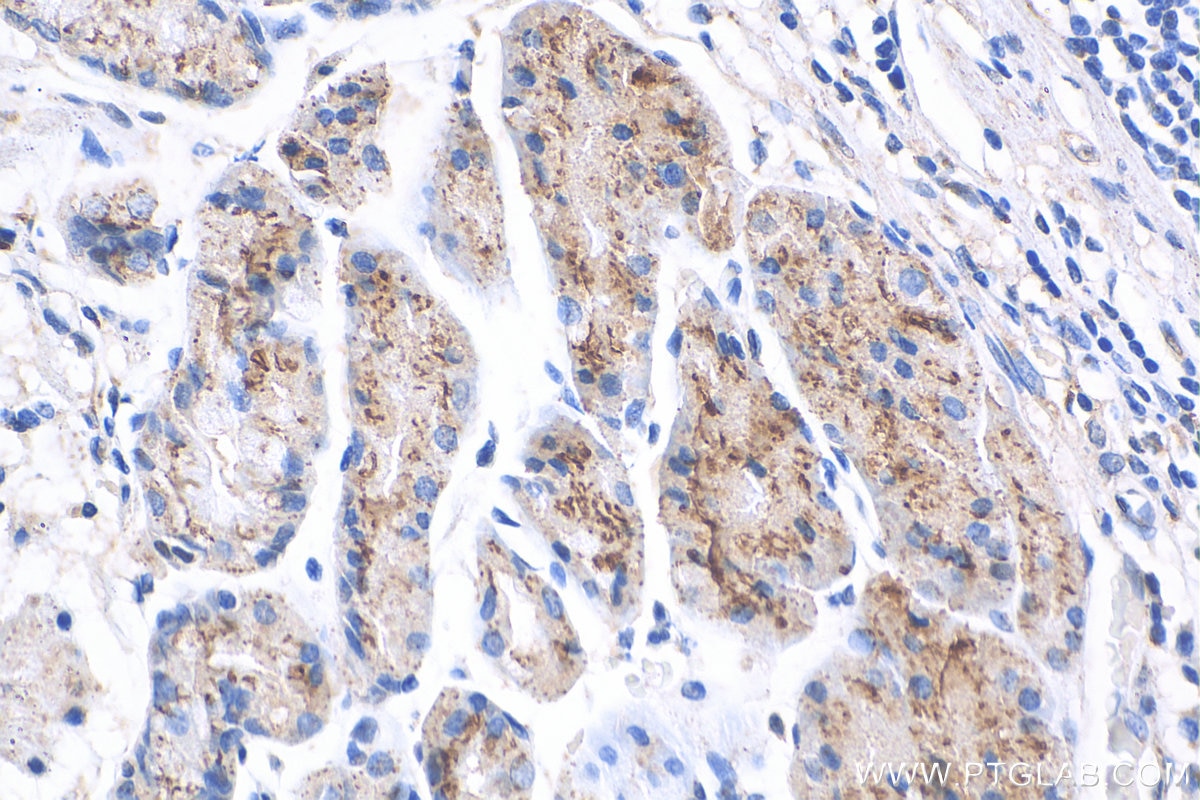 Immunohistochemistry (IHC) staining of human stomach cancer tissue using TM9SF4 Polyclonal antibody (29520-1-AP)