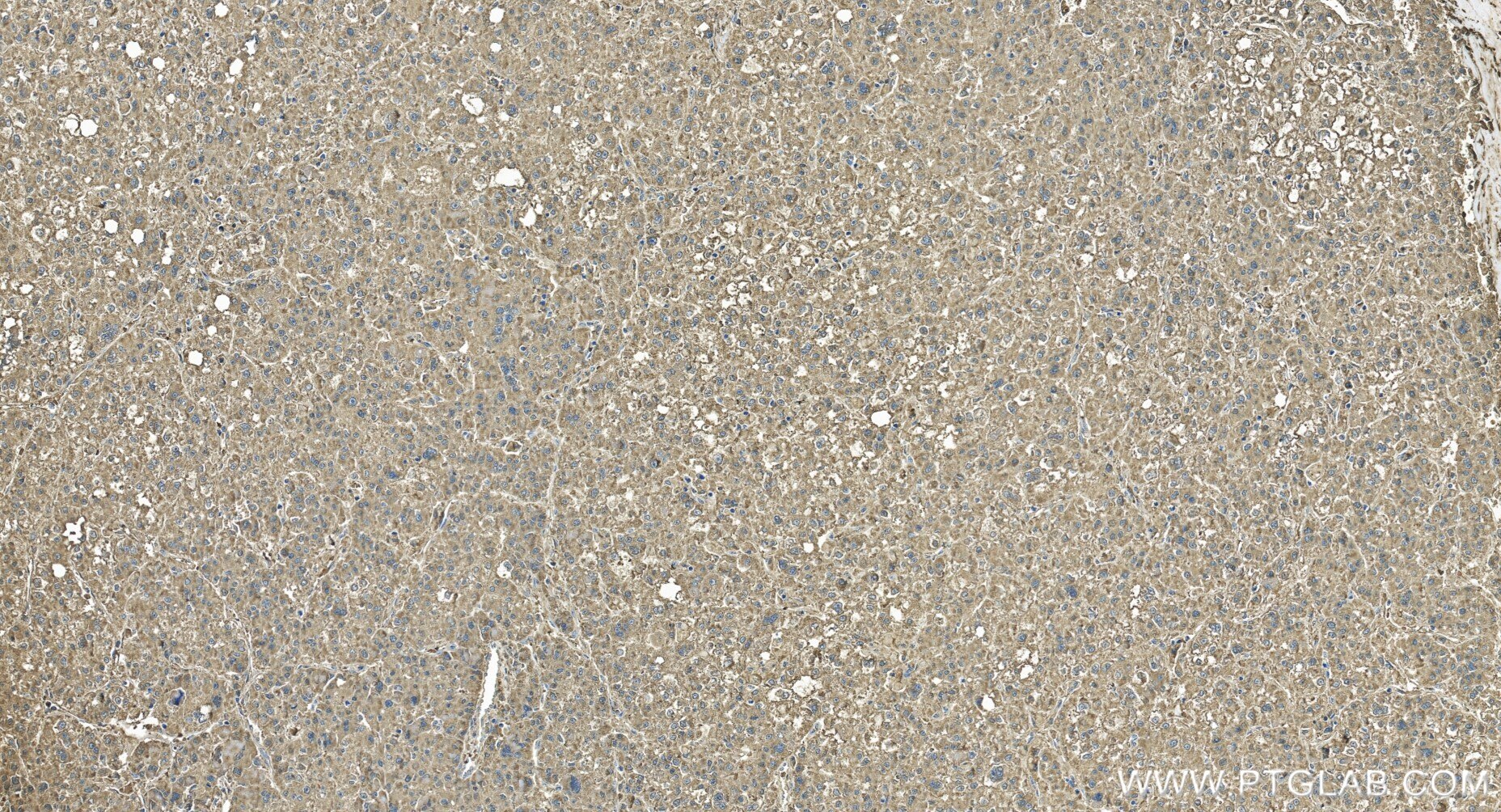 Immunohistochemistry (IHC) staining of human liver cancer tissue using TMCO1 Recombinant monoclonal antibody (86440-1-RR)