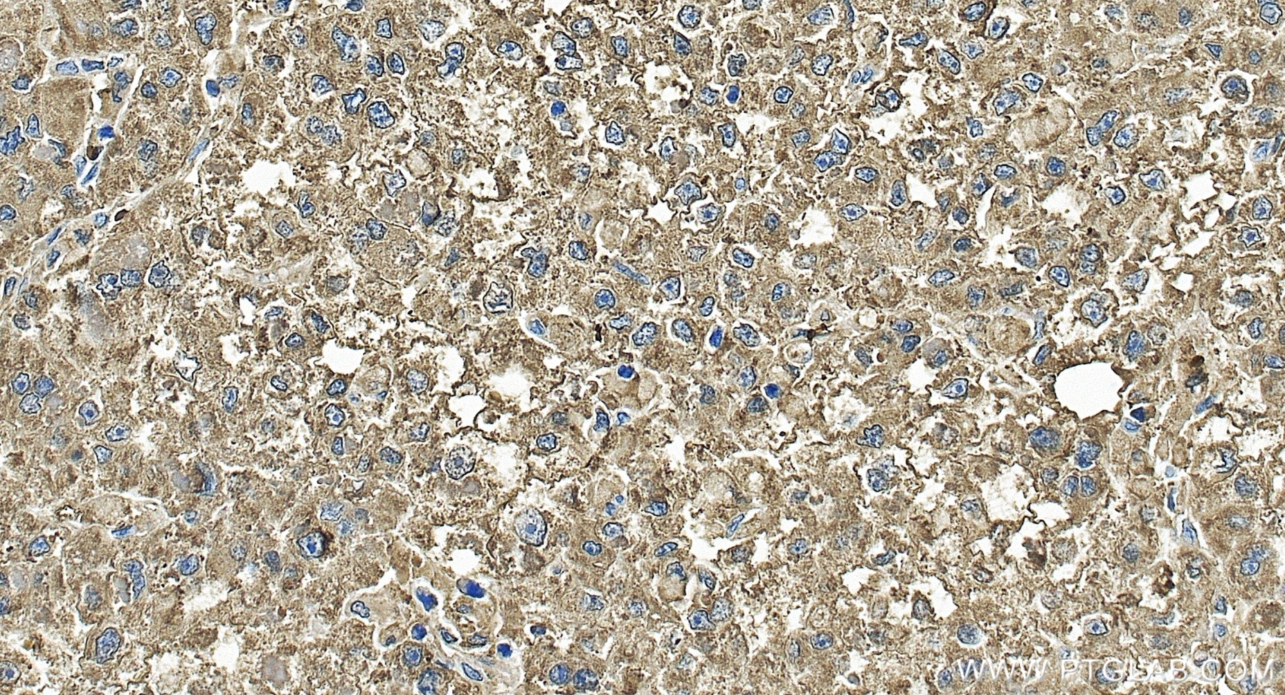 Immunohistochemistry (IHC) staining of human liver cancer tissue using TMCO1 Recombinant monoclonal antibody (86440-1-RR)
