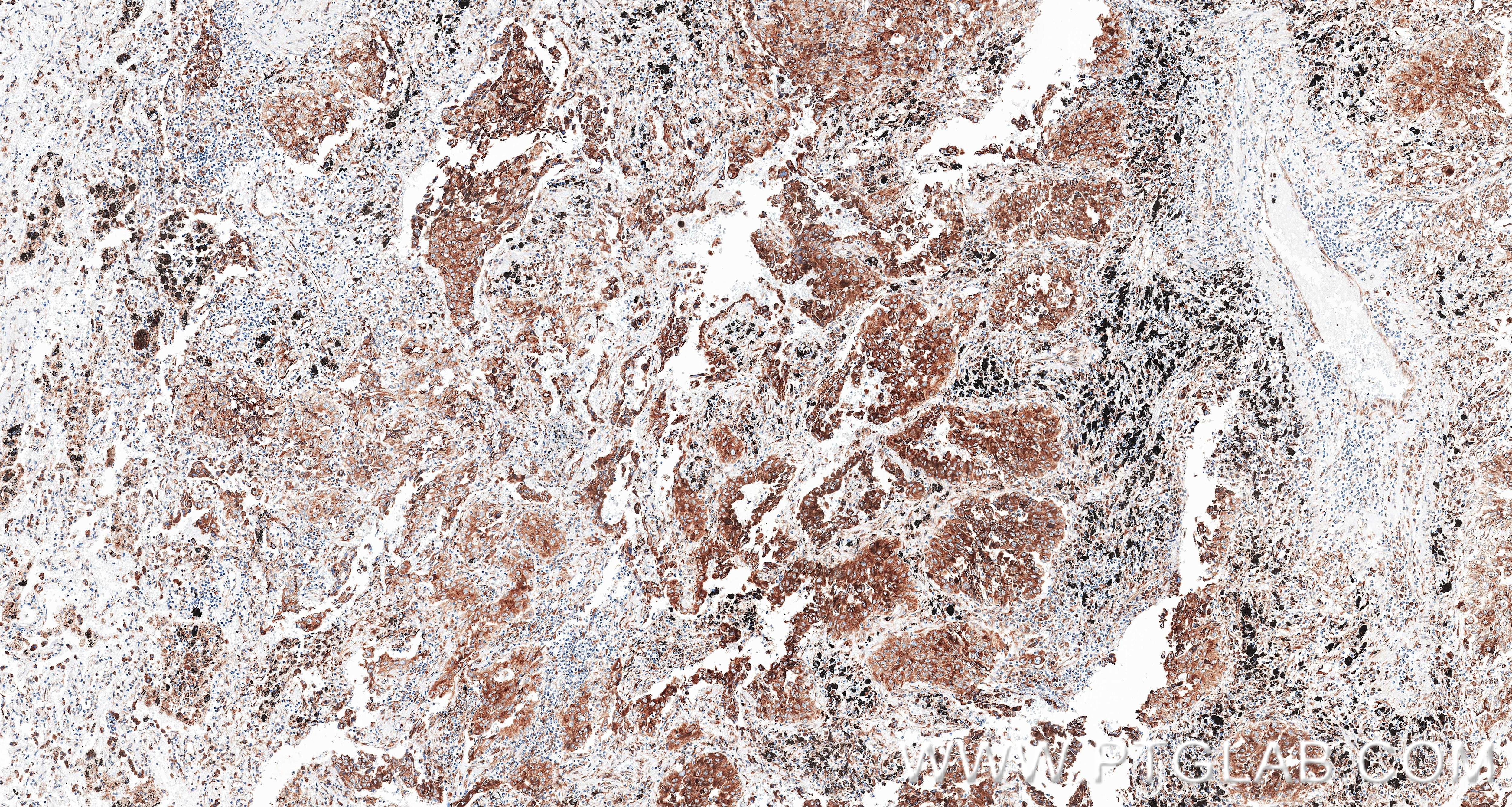 IHC staining of Human lung cancer (Adenocarcinoma) using 87837-1-RR (same clone as 87837-1-PBS) Immunohistochemistry (IHC) staining of Human lung cancer (Adenocarcinoma) using TMED1 Recombinant monoclonal antibody (87837-1-RR)