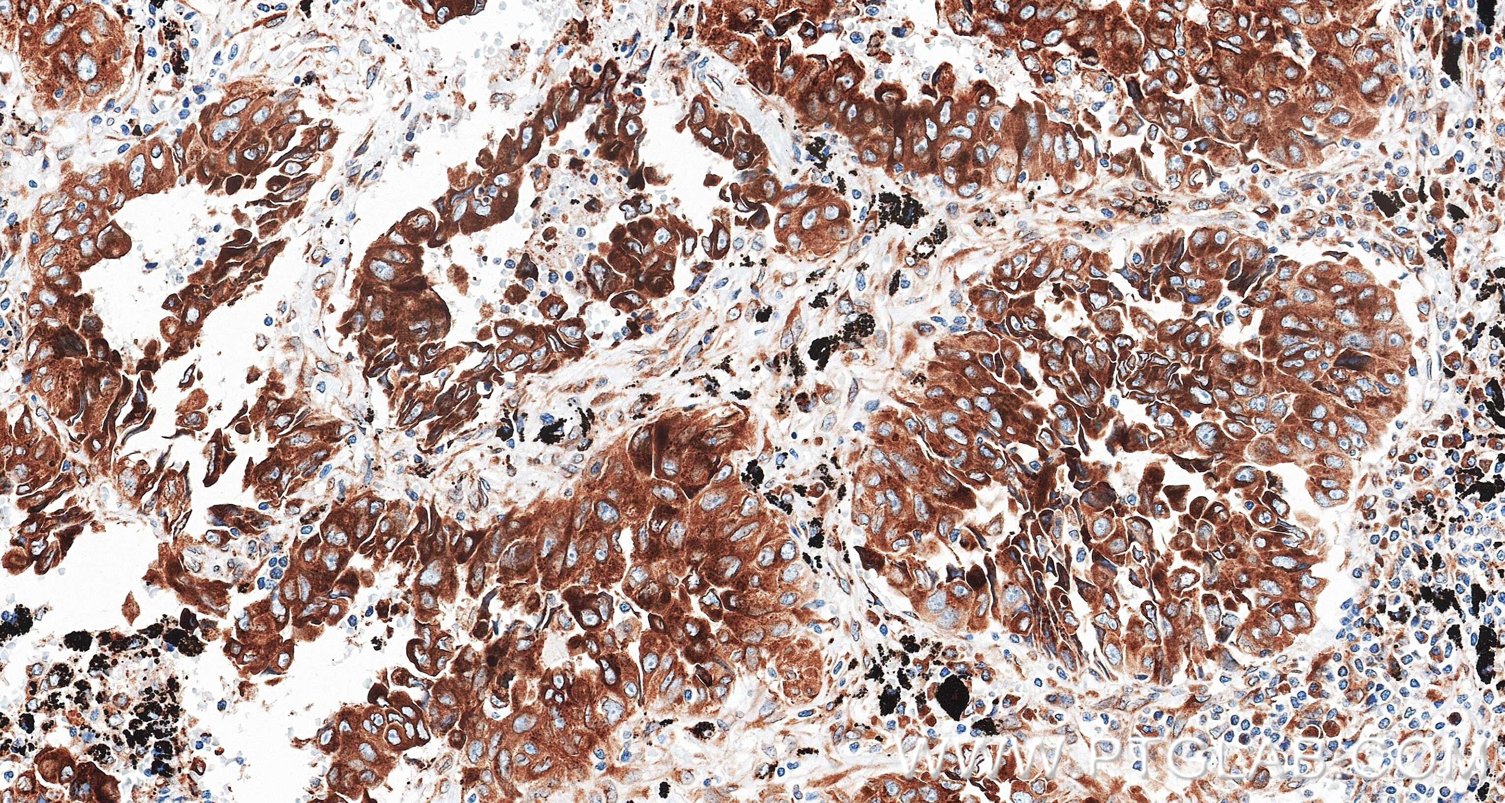IHC staining of Human lung cancer (Adenocarcinoma) using 87837-1-RR (same clone as 87837-1-PBS) Immunohistochemistry (IHC) staining of Human lung cancer (Adenocarcinoma) using TMED1 Recombinant monoclonal antibody (87837-1-RR)