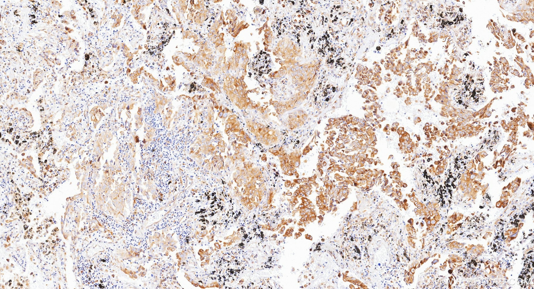 IHC staining of Human lung cancer (Adenocarcinoma) using Biotin-87837 Immunohistochemistry (IHC) staining of Human lung cancer (Adenocarcinoma) using Biotin-conjugated TMED1 Recombinant monoclonal ant (Biotin-87837)