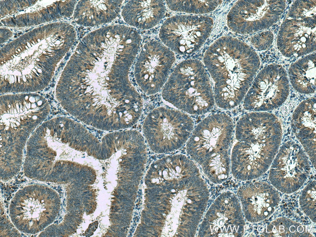 Immunohistochemistry (IHC) staining of human colon cancer tissue using TMP21 Polyclonal antibody (15199-1-AP)