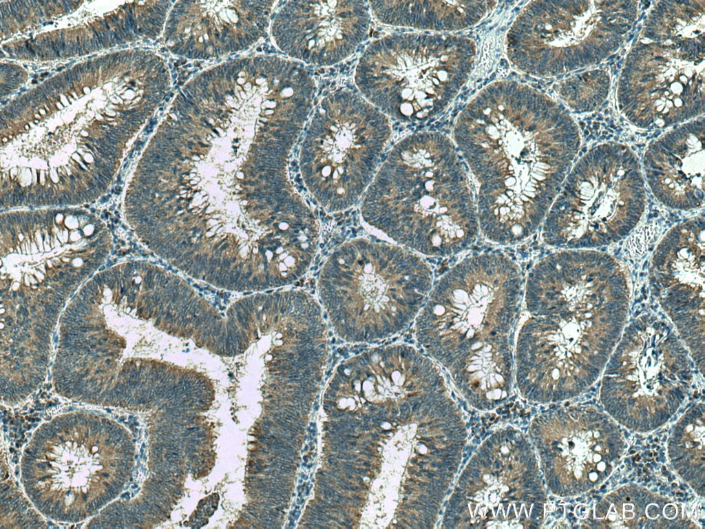 IHC staining of human colon cancer using 15199-1-AP