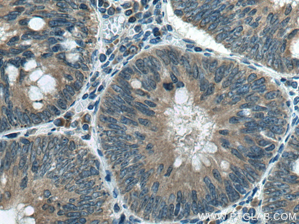 Immunohistochemistry (IHC) staining of human colon cancer tissue using TMP21 Polyclonal antibody (15199-1-AP)