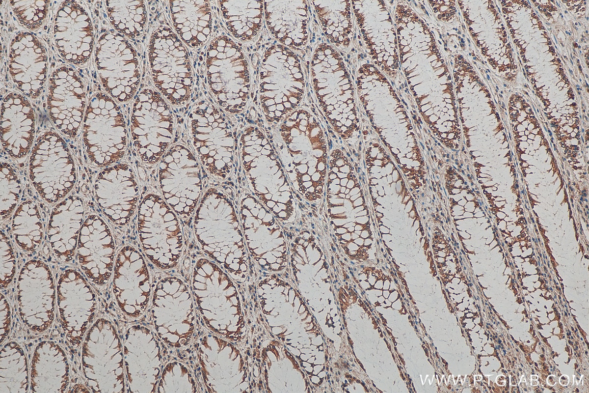 Immunohistochemistry (IHC) staining of human colon cancer tissue using TMED10 Monoclonal antibody (67876-1-Ig)