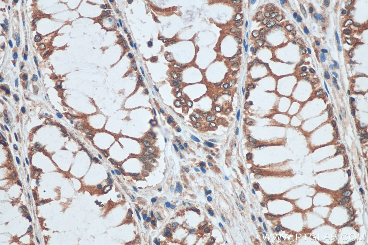Immunohistochemistry (IHC) staining of human colon cancer tissue using TMED10 Monoclonal antibody (67876-1-Ig)