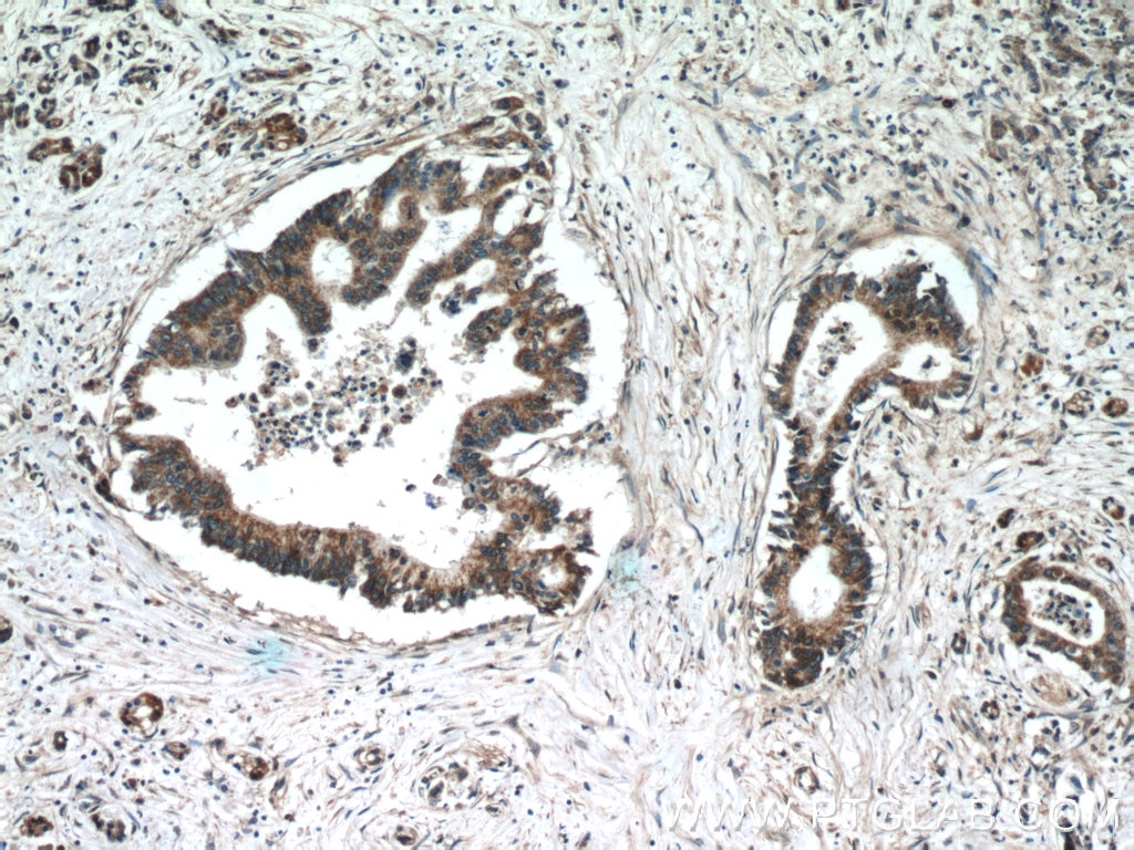 Immunohistochemistry (IHC) staining of human pancreas cancer tissue using TMED2 Polyclonal antibody (11981-1-AP)