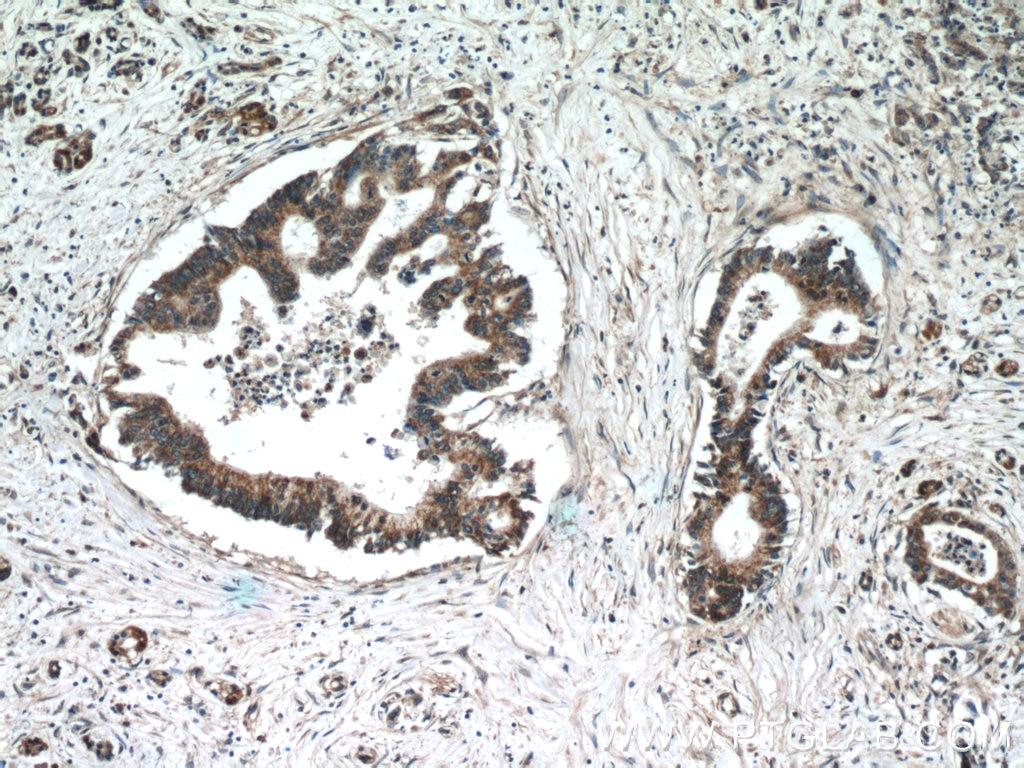 IHC staining of human pancreas cancer using 11981-1-AP