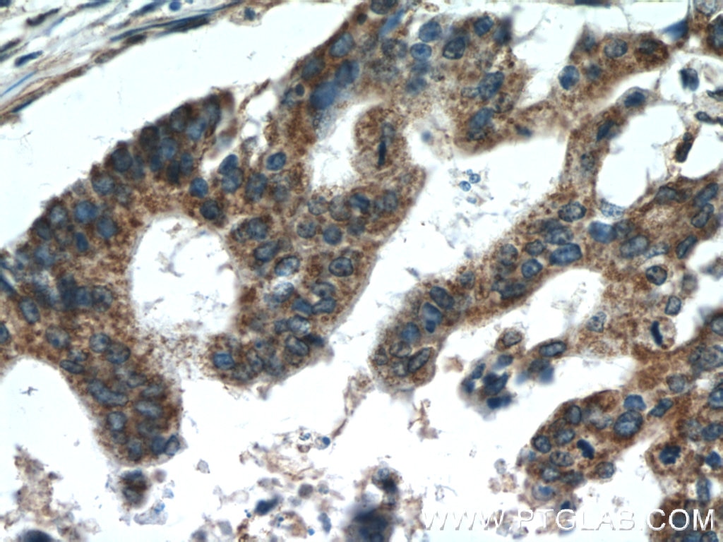 Immunohistochemistry (IHC) staining of human pancreas cancer tissue using TMED2 Polyclonal antibody (11981-1-AP)