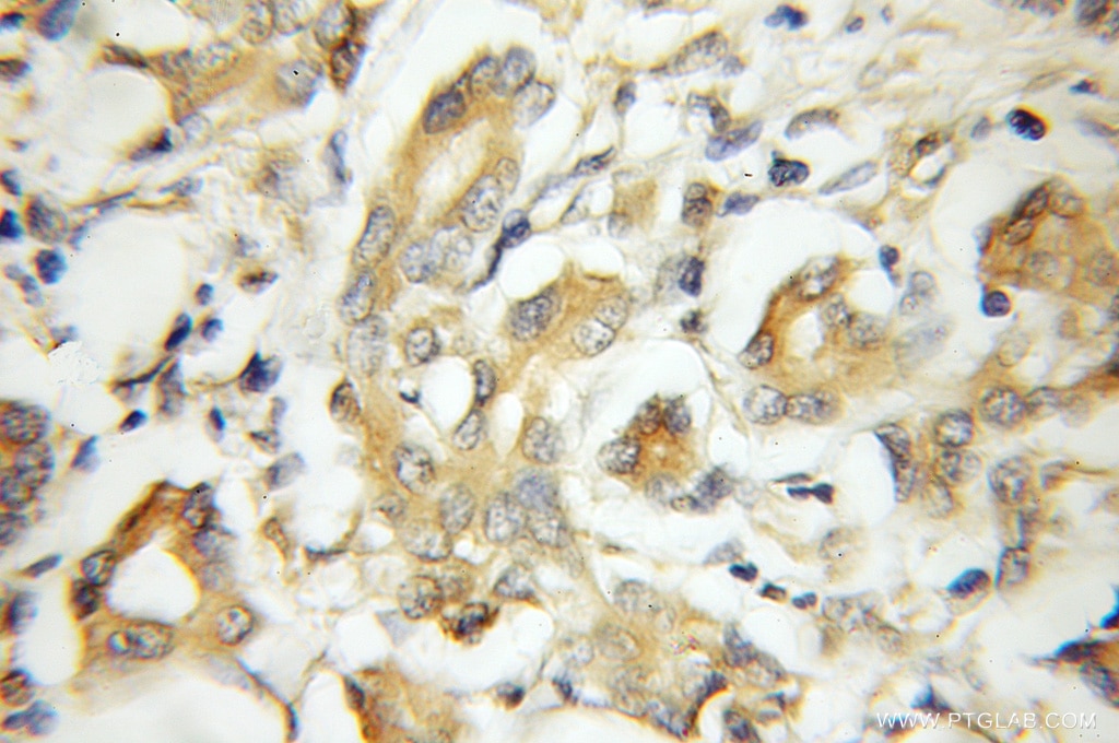 Immunohistochemistry (IHC) staining of human pancreas cancer tissue using TMED2 Polyclonal antibody (11981-1-AP)