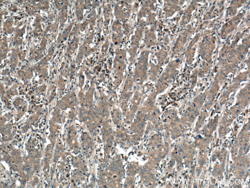 Immunohistochemistry (IHC) staining of human stomach cancer tissue using TMEM100 Polyclonal antibody (25581-1-AP)