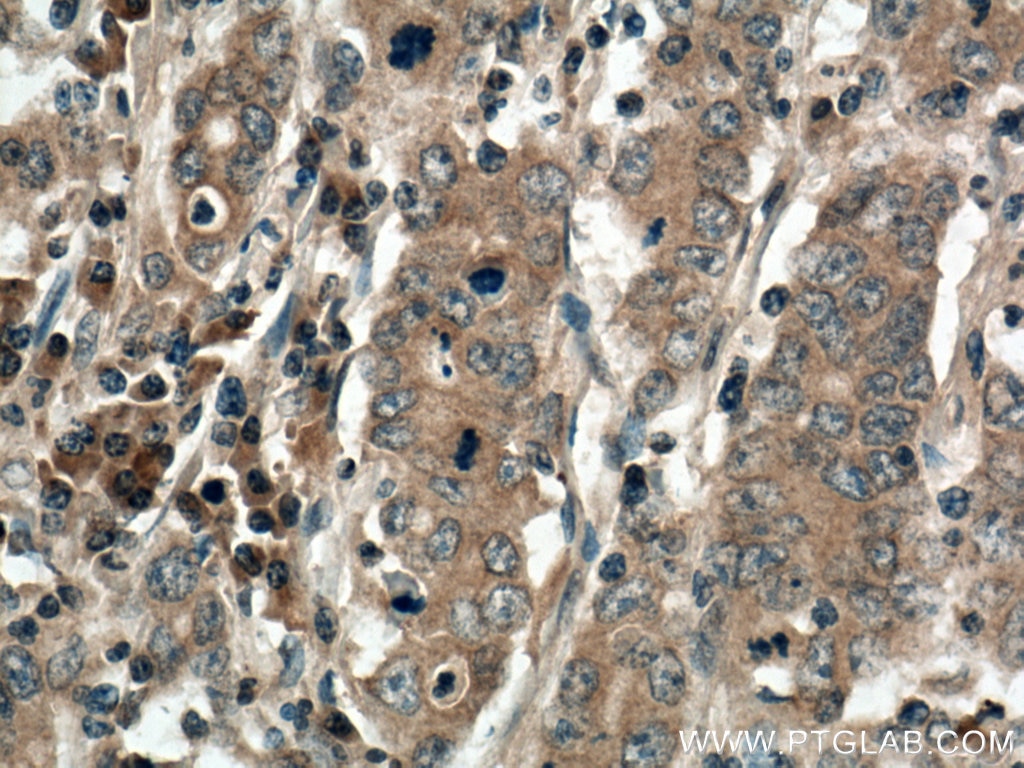 Immunohistochemistry (IHC) staining of human stomach cancer tissue using TMEM100 Polyclonal antibody (25581-1-AP)