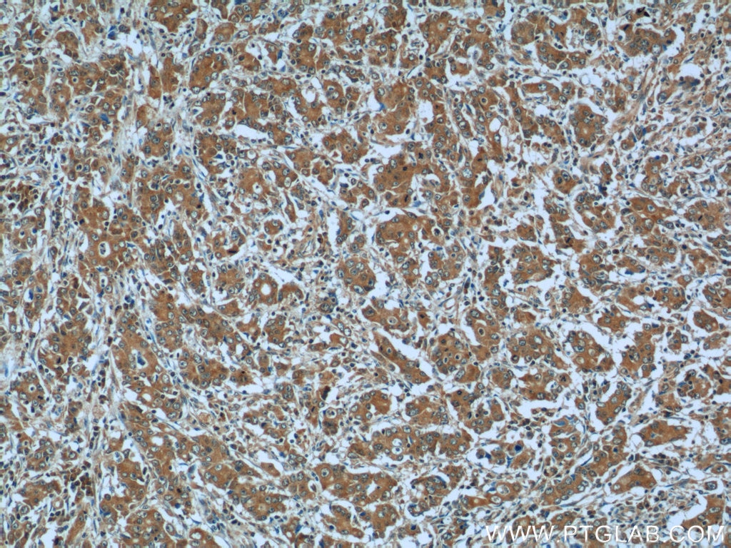 Immunohistochemistry (IHC) staining of human stomach cancer tissue using TMEM100 Polyclonal antibody (25581-1-AP)