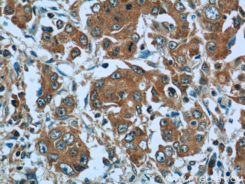 Immunohistochemistry (IHC) staining of human stomach cancer tissue using TMEM100 Polyclonal antibody (25581-1-AP)