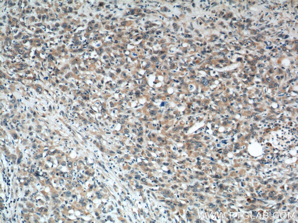 Immunohistochemistry (IHC) staining of human stomach cancer tissue using TMEM106A Polyclonal antibody (20460-1-AP)
