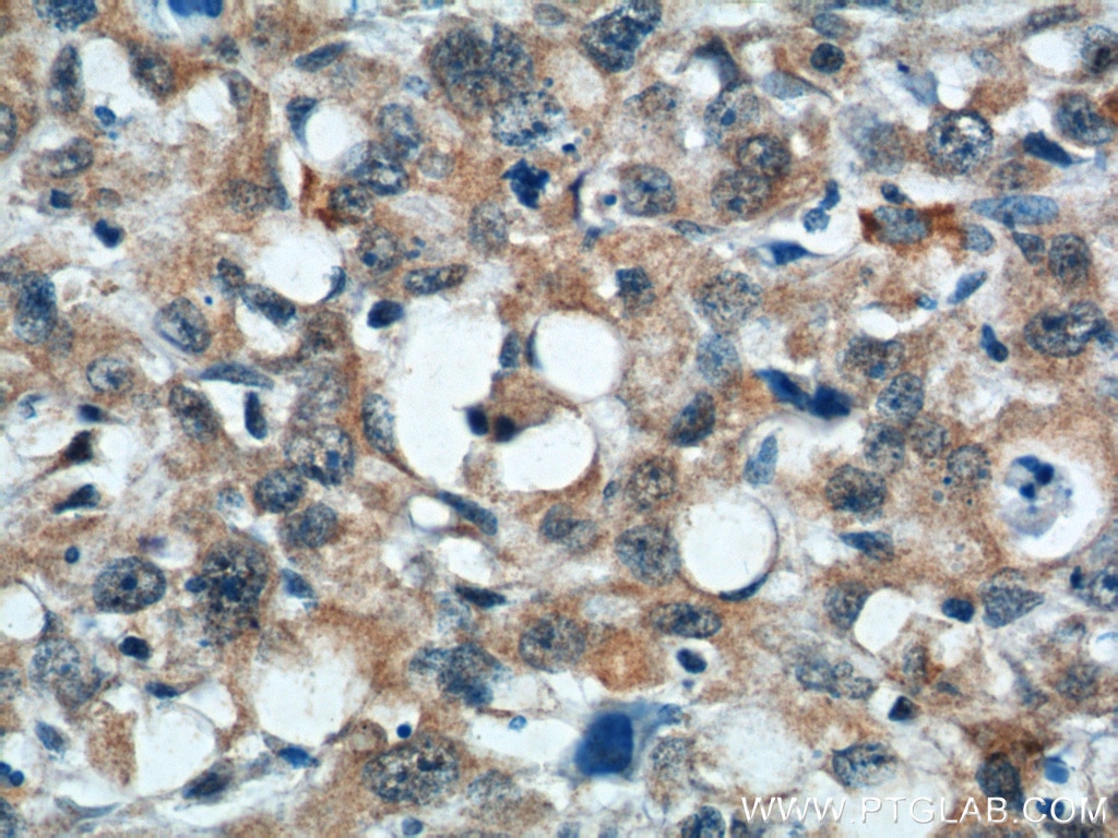 Immunohistochemistry (IHC) staining of human stomach cancer tissue using TMEM106A Polyclonal antibody (20460-1-AP)