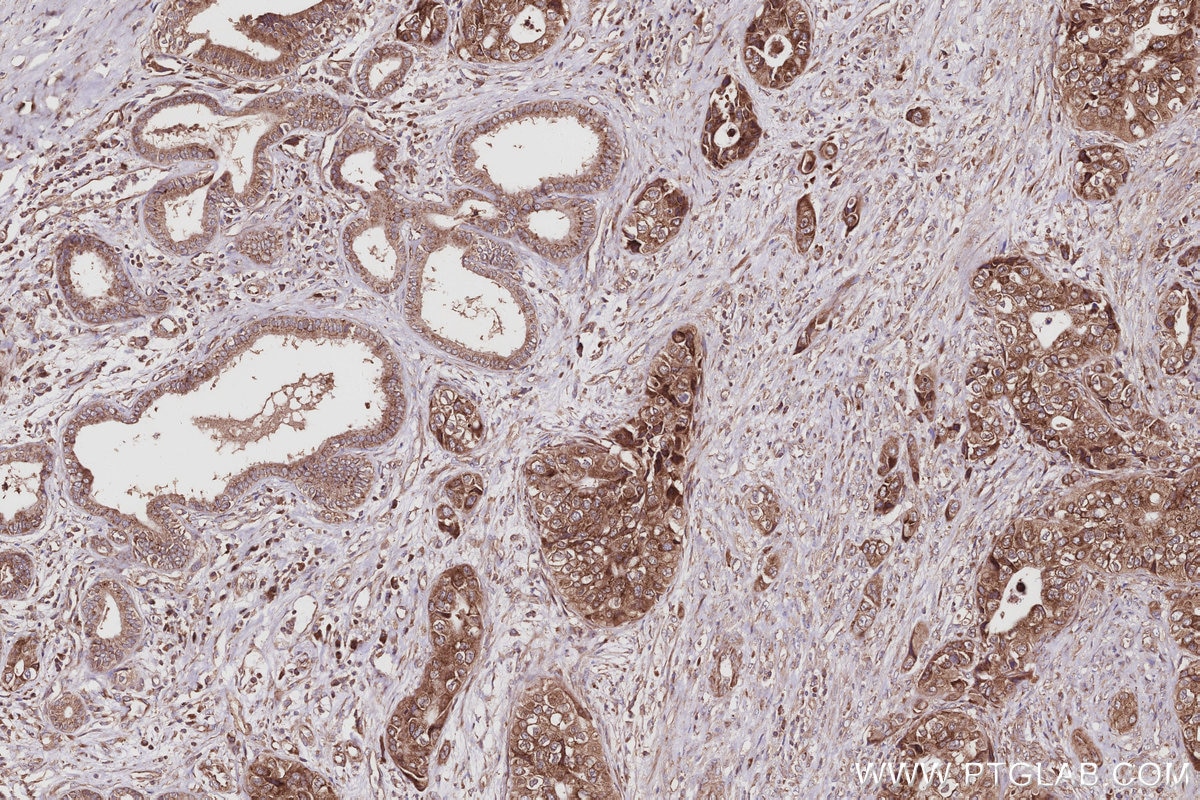 IHC staining of human pancreas cancer using 67205-1-Ig Immunohistochemistry (IHC) staining of human pancreas cancer tissue using TMEM111 Monoclonal antibody (67205-1-Ig)