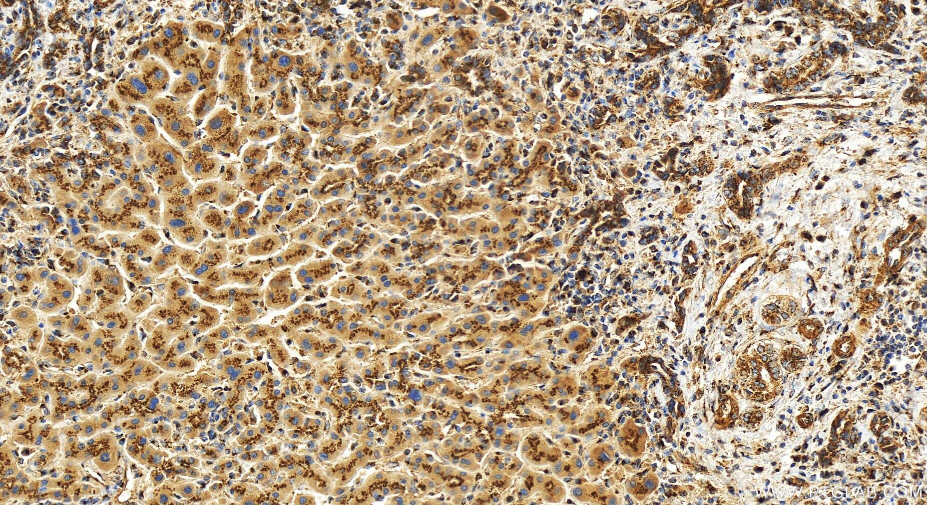 Immunohistochemistry (IHC) staining of human intrahepatic cholangiocarcinoma tissue using TMEM115 Polyclonal antibody (25536-1-AP)