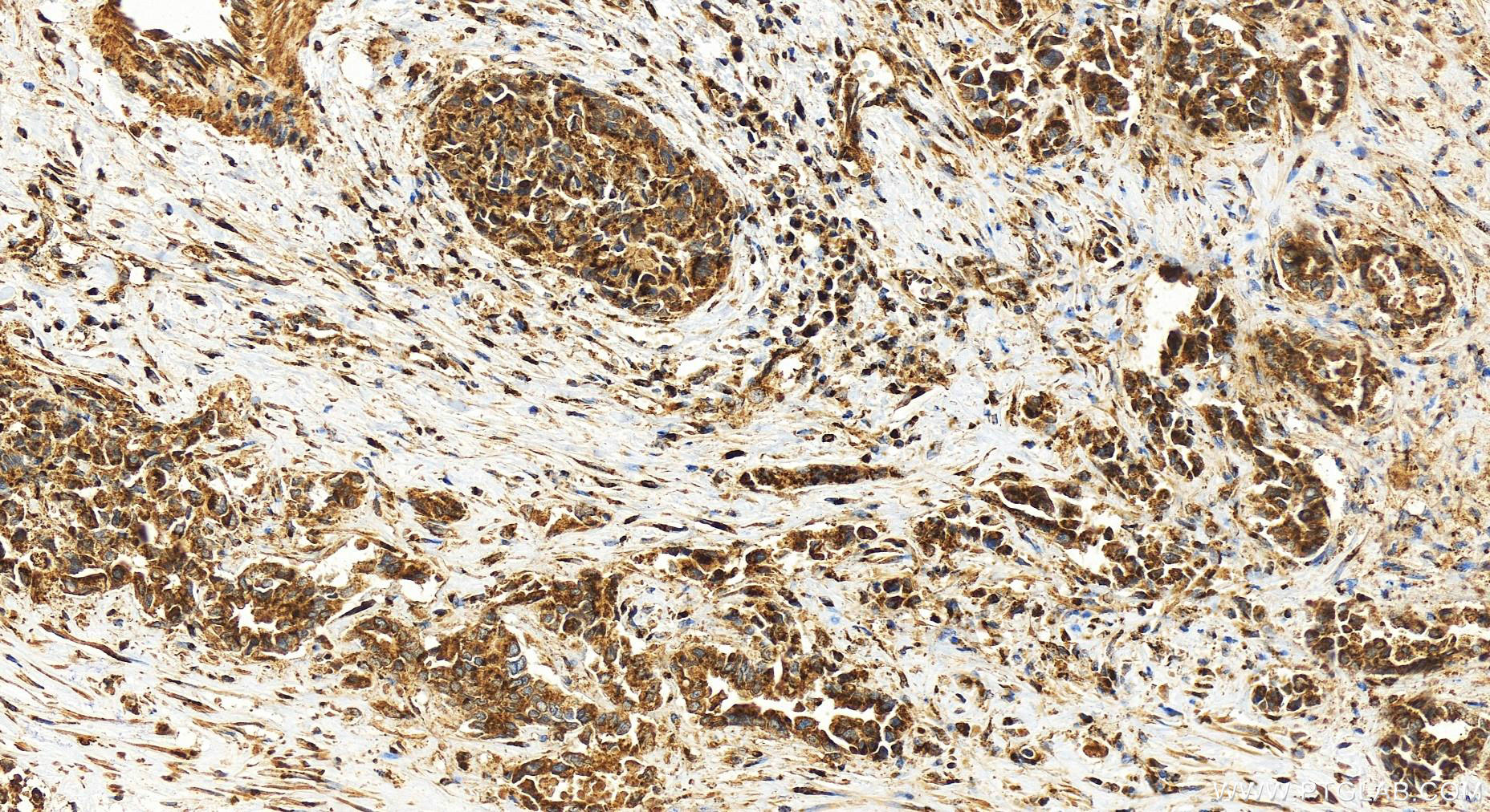 Immunohistochemistry (IHC) staining of human intrahepatic cholangiocarcinoma tissue using TMEM115 Polyclonal antibody (25536-1-AP)