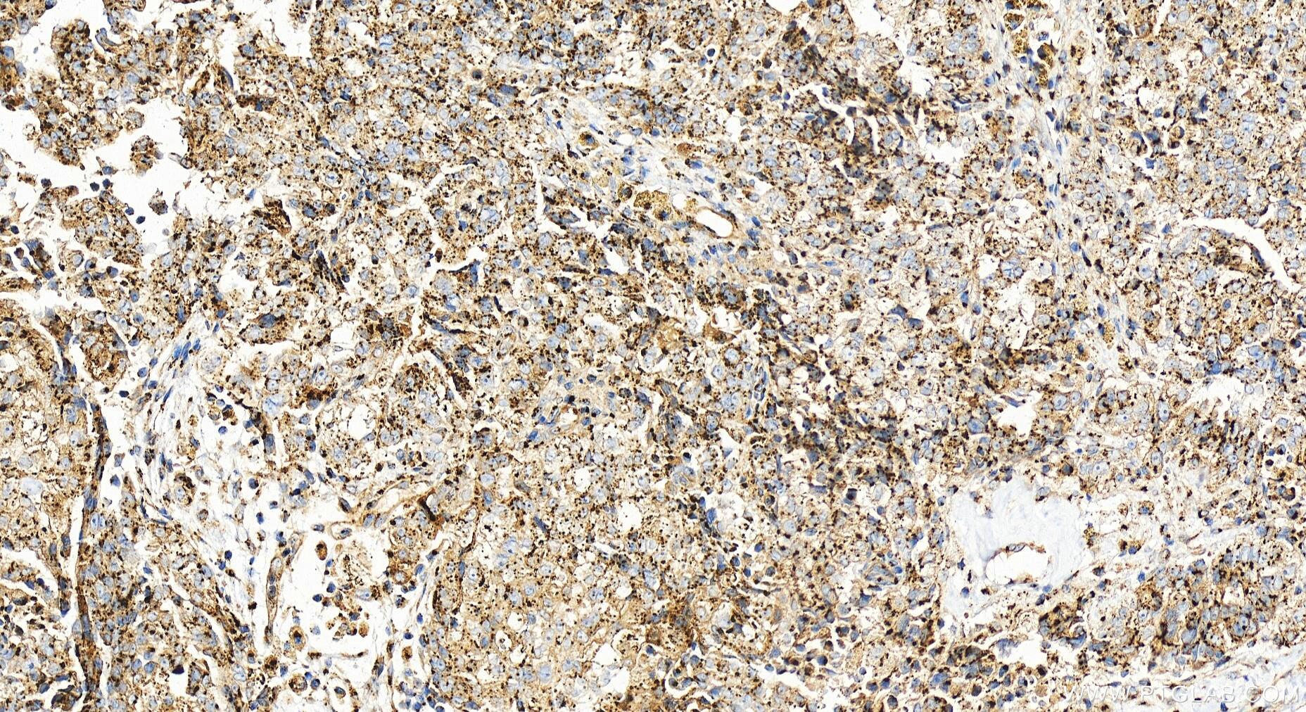 Immunohistochemistry (IHC) staining of human ovary cancer tissue using TMEM115 Polyclonal antibody (25536-1-AP)
