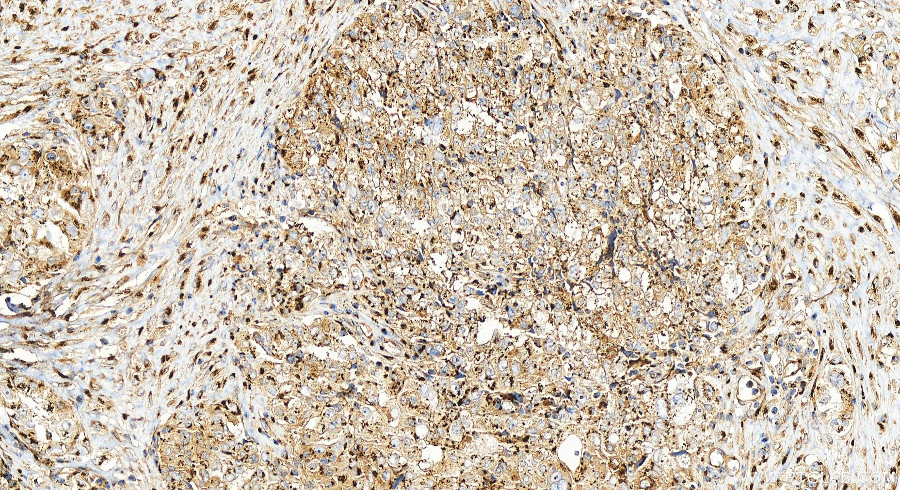 Immunohistochemistry (IHC) staining of human ovary cancer tissue using TMEM115 Polyclonal antibody (25536-1-AP)