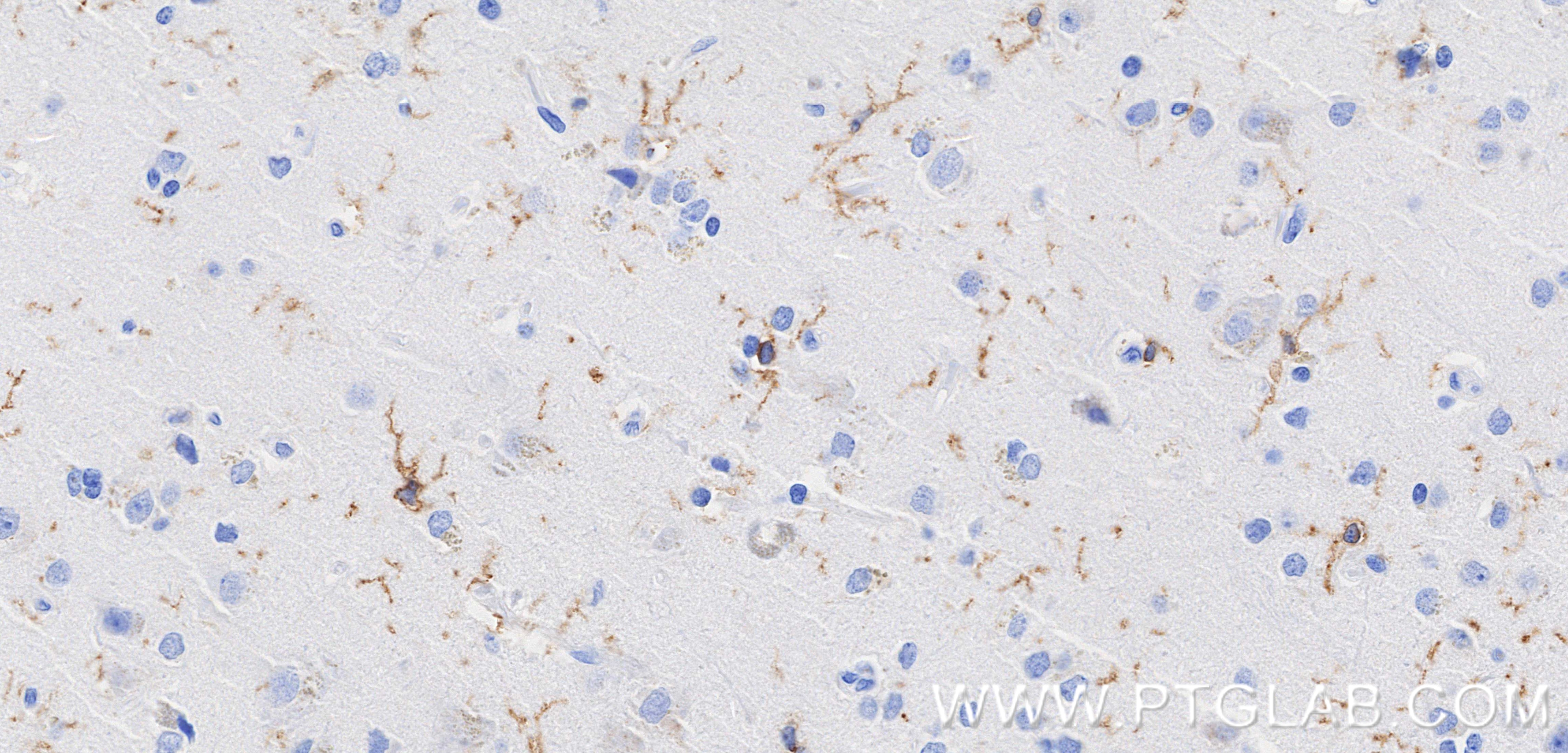 IHC staining of Human brain cancer(Astrocitoma) using 83448-9-RR Immunohistochemistry (IHC) staining of Human brain cancer(Astrocitoma) using TMEM119 Recombinant monoclonal antibody (83448-9-RR)