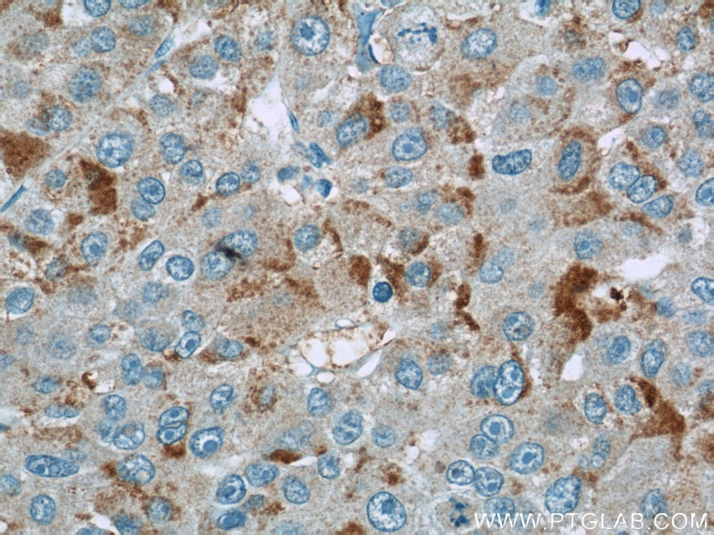 Immunohistochemistry (IHC) staining of human liver cancer tissue using TMEM127 Polyclonal antibody (23142-1-AP)