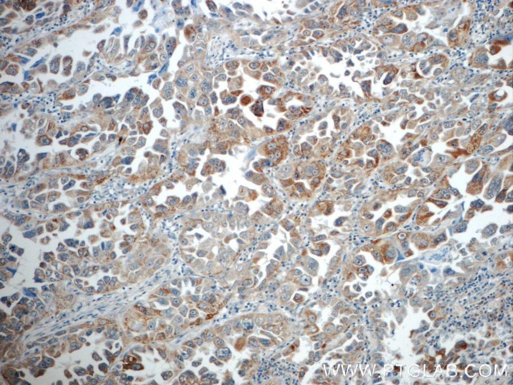 Immunohistochemistry (IHC) staining of human lung cancer tissue using TMEM139 Polyclonal antibody (21912-1-AP)