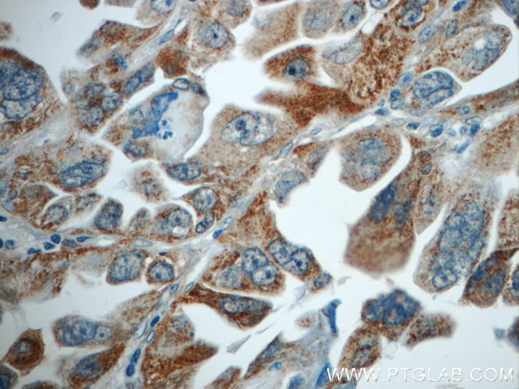 Immunohistochemistry (IHC) staining of human lung cancer tissue using TMEM139 Polyclonal antibody (21912-1-AP)