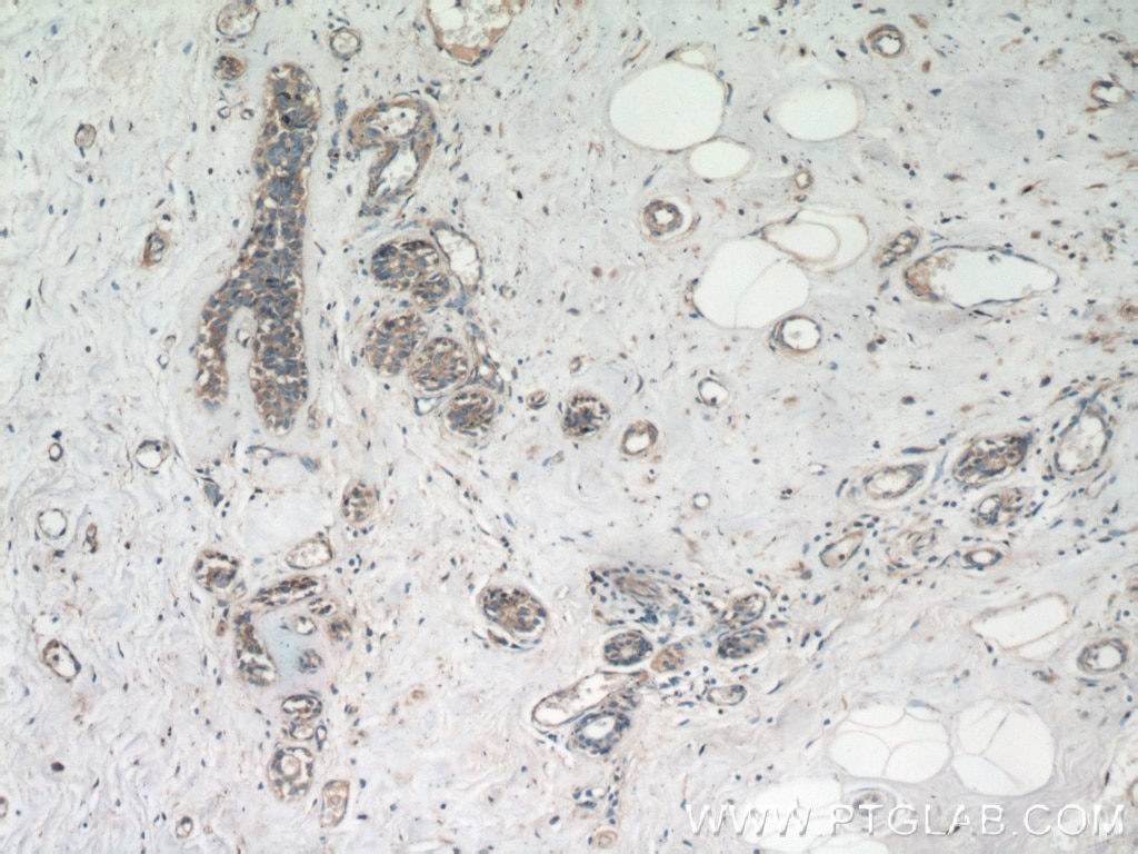 Immunohistochemistry (IHC) staining of human breast cancer tissue using TMEM154 Polyclonal antibody (24812-1-AP)