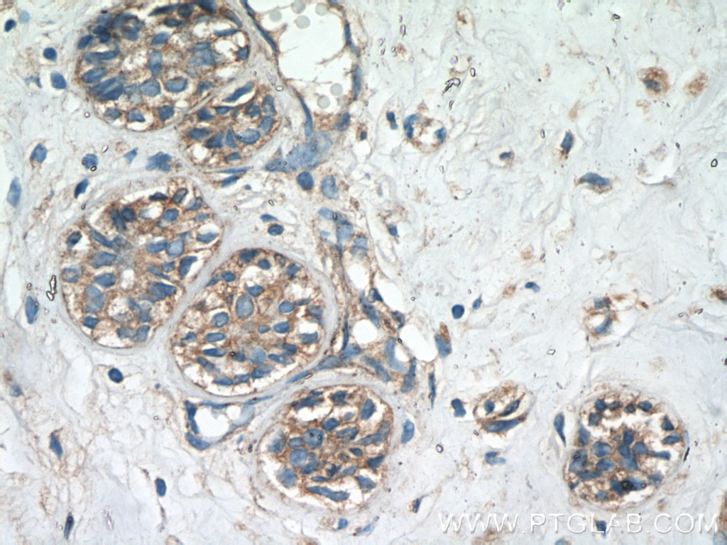 Immunohistochemistry (IHC) staining of human breast cancer tissue using TMEM154 Polyclonal antibody (24812-1-AP)