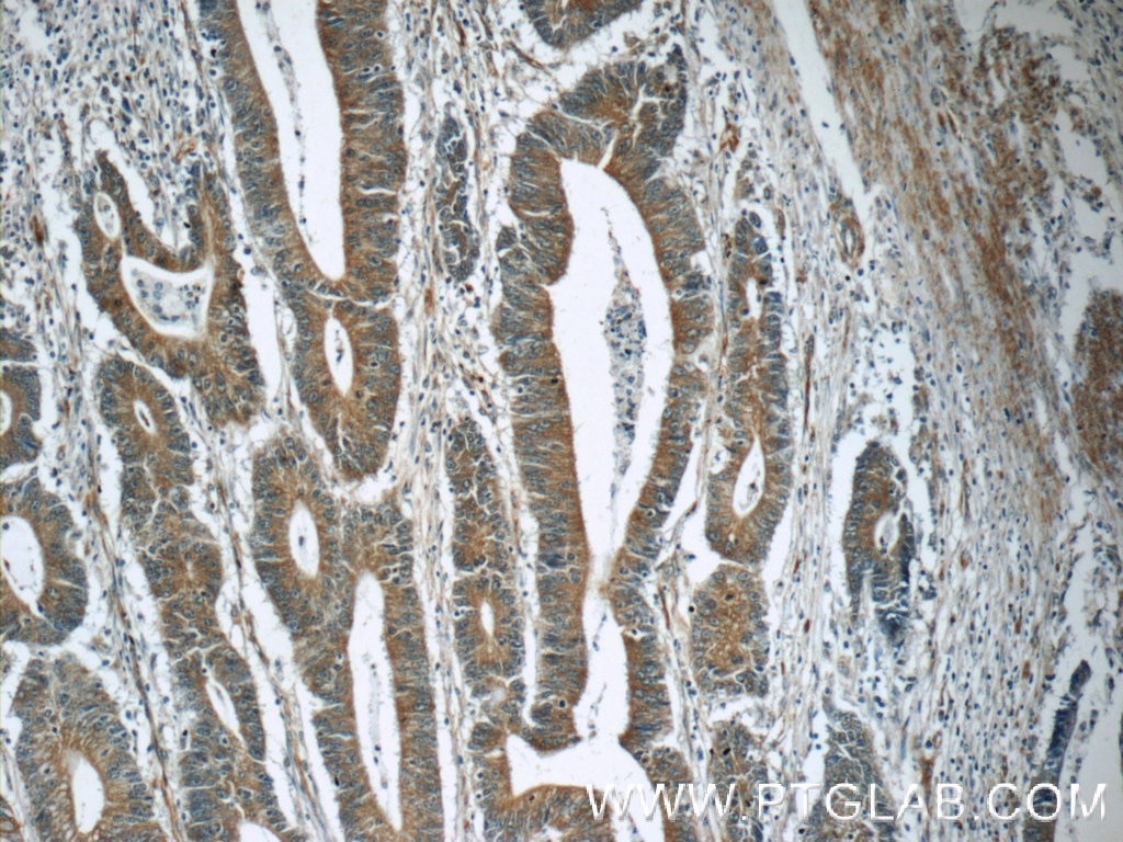 Immunohistochemistry (IHC) staining of human colon cancer tissue using TMEM156 Polyclonal antibody (25159-1-AP)