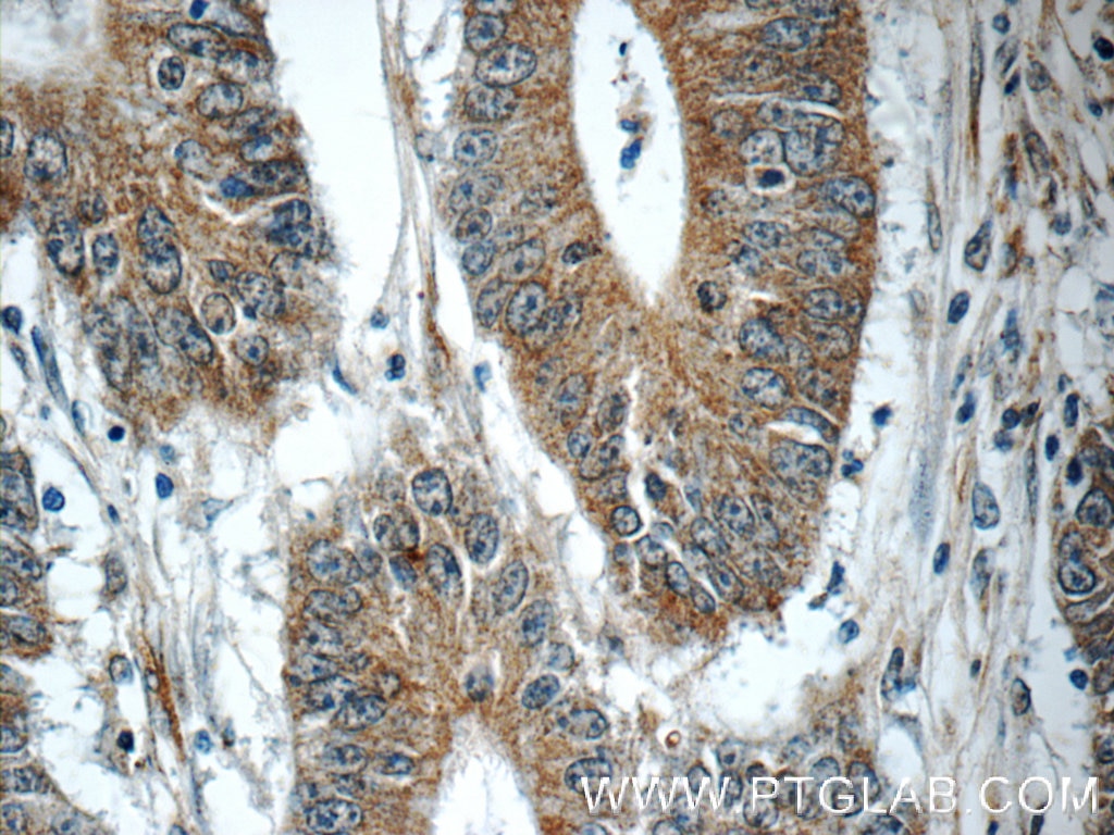 Immunohistochemistry (IHC) staining of human colon cancer tissue using TMEM156 Polyclonal antibody (25159-1-AP)