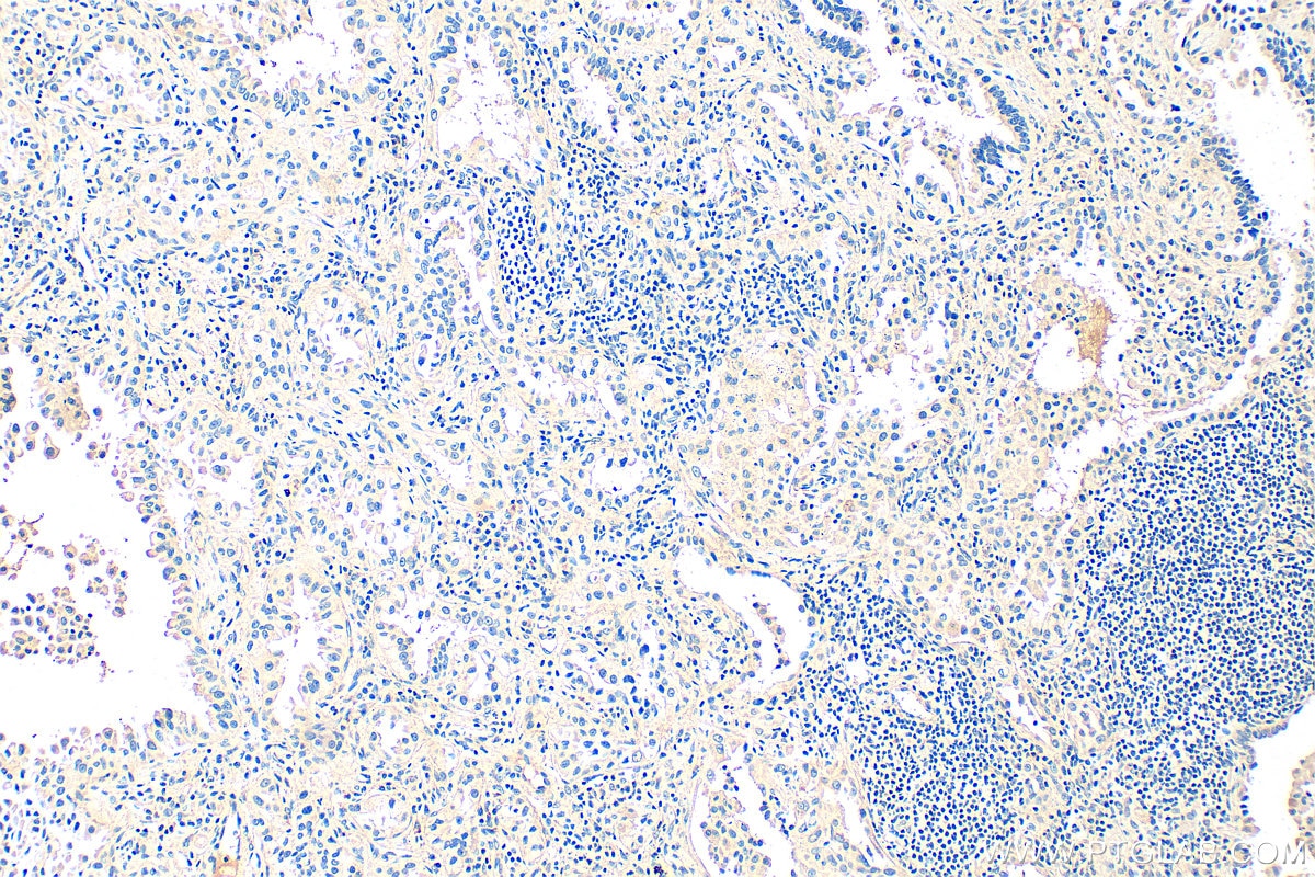 Immunohistochemistry (IHC) staining of human lung cancer tissue using TMEM16A/DOG1 Polyclonal antibody (33212-1-AP)