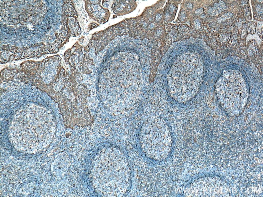 Immunohistochemistry (IHC) staining of human tonsillitis tissue using TMEM173/STING Polyclonal antibody (19851-1-AP)